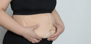 How Much Does Liposuction Cost in Arlington Virginia